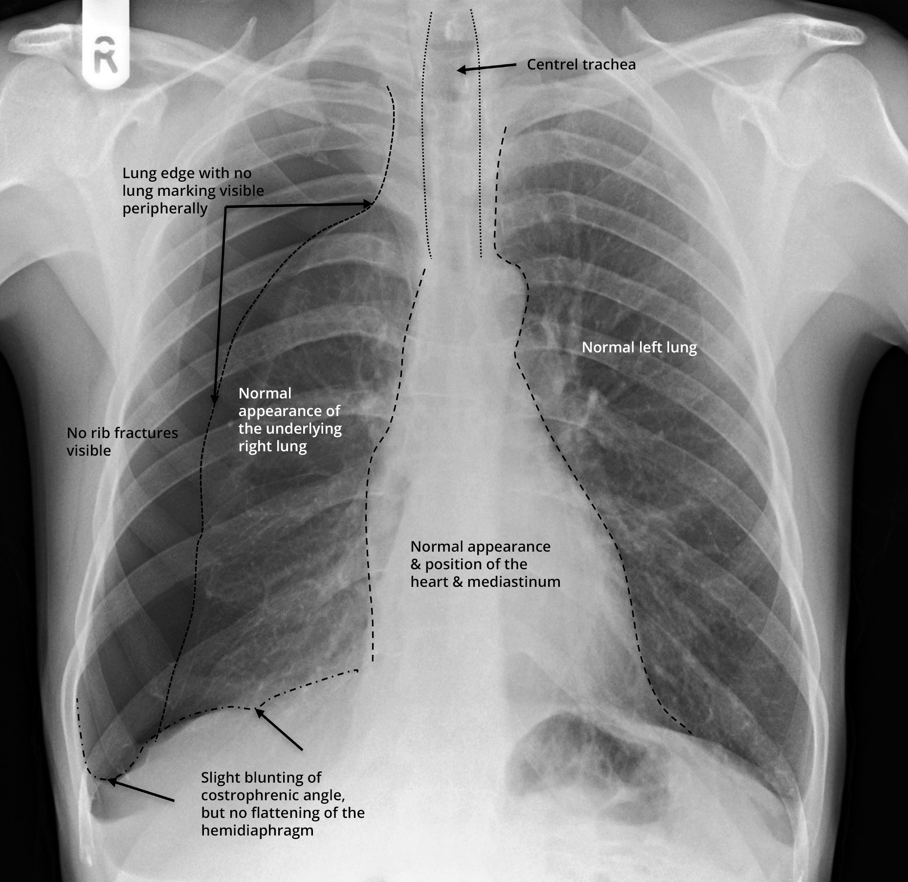 The Unoffical Guide To Radiology - Annotated X- Ray