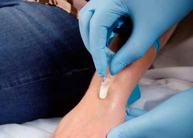 Cannulation - Clean Insertion Site image