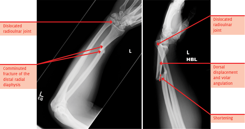 orthopaedic x-rays - Annotated X-Ray image